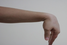 An Introduction to Wrist Arthroscopy