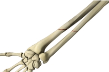 Broken Forearm: Radius, Ulna, and Both Bone Fractures