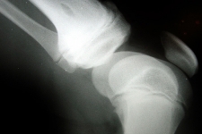 Is Knee Replacement Right for You?