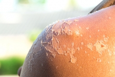 More Than Skin Deep: The Anatomy of a Sunburn – Part 2