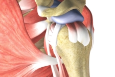 Stiff shoulders after rotator cuff repair may be less likely to require revision surgery