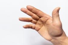 What is Dupuytren’s Contracture?