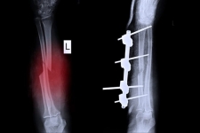 What Is Internal Fixation?