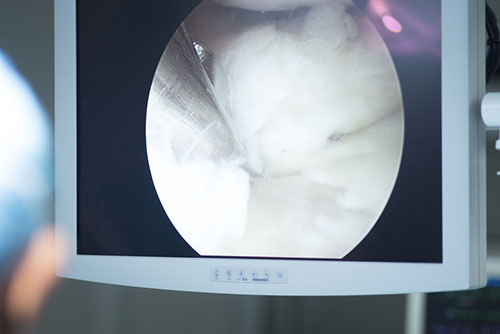 Arthroscopy Procedures