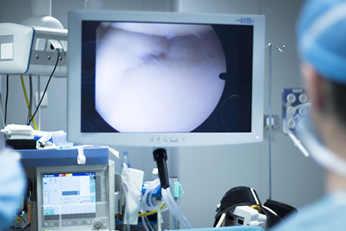 What is Arthroscopic Surgery?