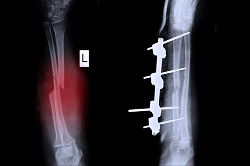 Internal Fixation