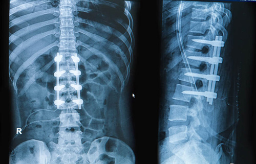 Spinal Fusion